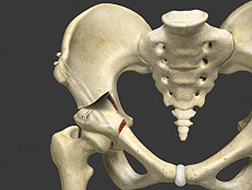 peri-acetabulaire osteotomie