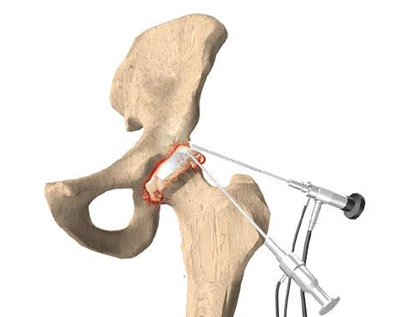 Young Adult Hip Clinic