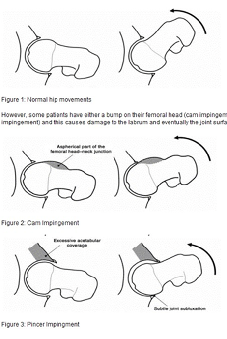 impingement